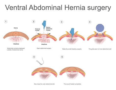 lv lhr|incisional hernia repair guidelines.